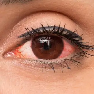 Red Eye Clinic In Vaughan & Woodbridge